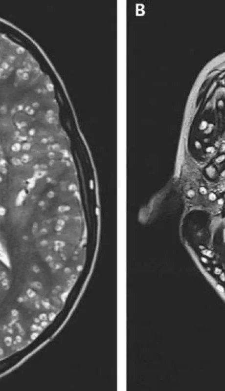 Parasitos-en-el-cerebro