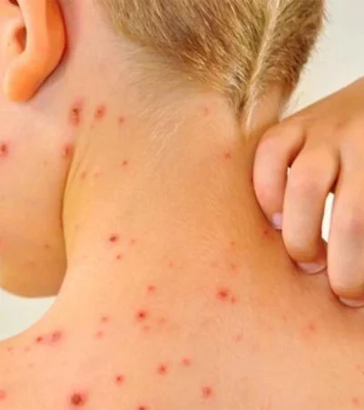 sarampión-mendoza-virus-vacunas-enfermedad-efectos-2