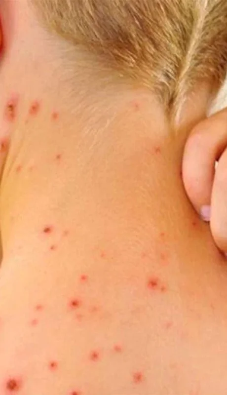 sarampión-mendoza-virus-vacunas-enfermedad-efectos-2