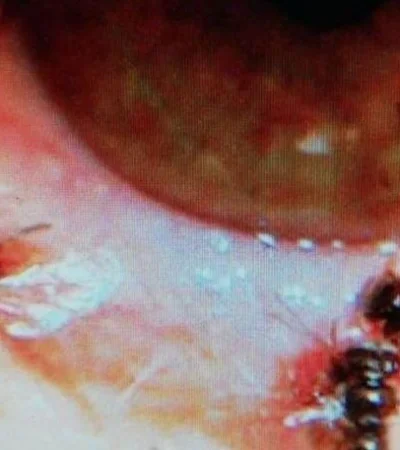 taiwan-mujer-con-abejas-vivas-en-el-interior-del-ojo