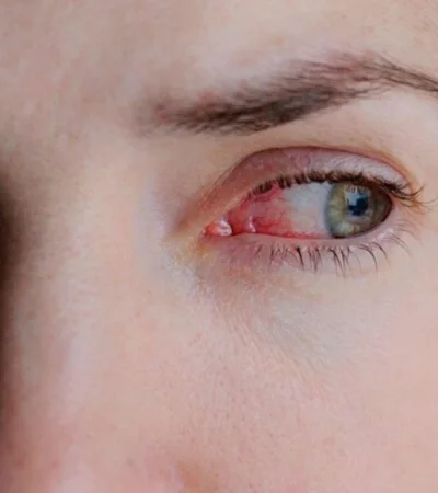 coronavirus-conjuntivitis-foto-síntomas