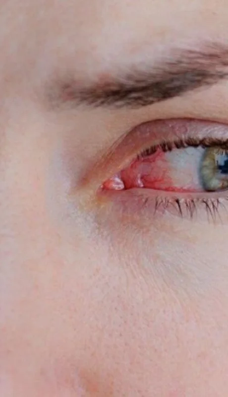coronavirus-conjuntivitis-foto-síntomas