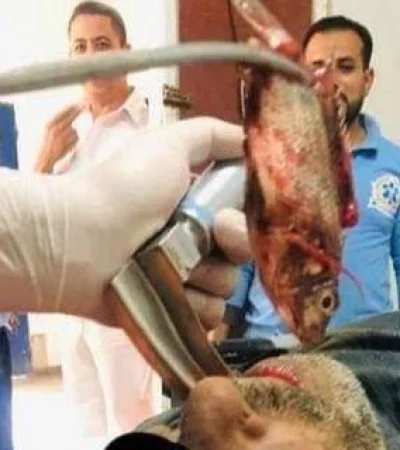 medicos-extraen-un-pez-vivo-de-la-garganta