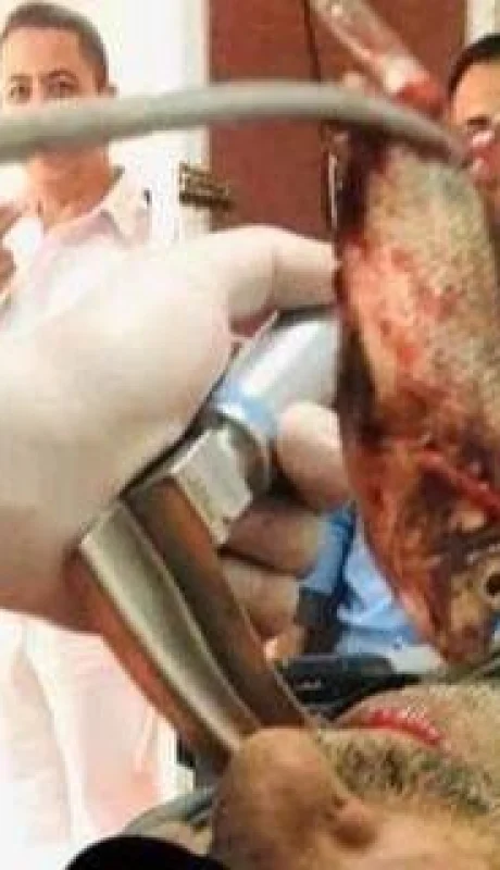 medicos-extraen-un-pez-vivo-de-la-garganta