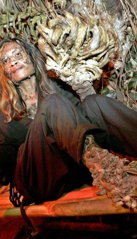 hombre_a?rbol_si?ndrome