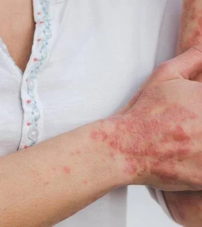 psoriasis-