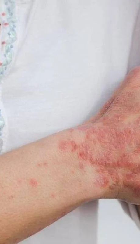 psoriasis-