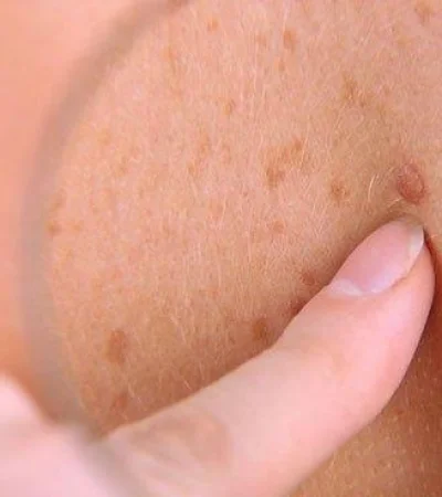 el-teledermatoscopio-mejora-el-diagnostico-de-cancer-de-piel-5945_620x368