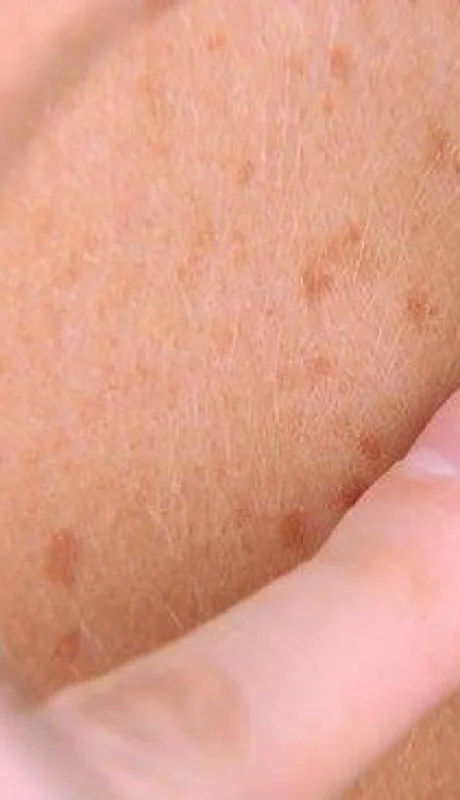 el-teledermatoscopio-mejora-el-diagnostico-de-cancer-de-piel-5945_620x368