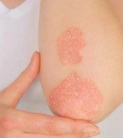 PSORIASIS-(1)