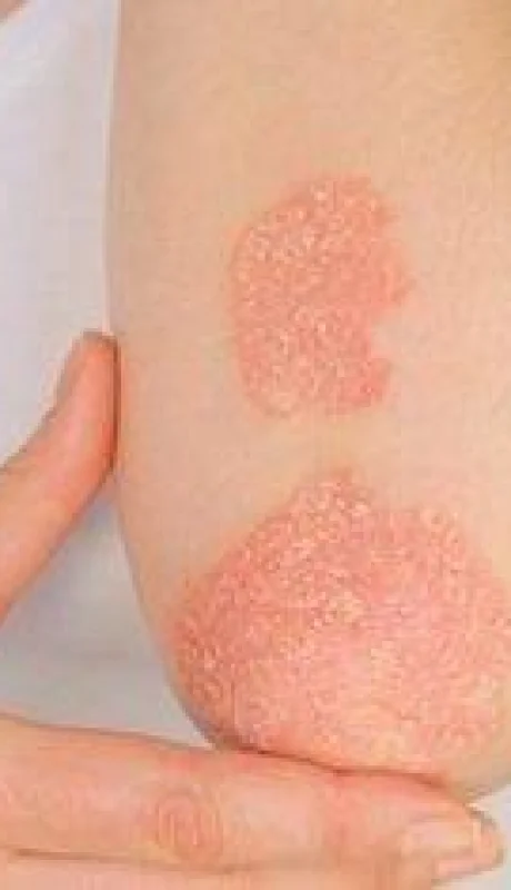 PSORIASIS-(1)