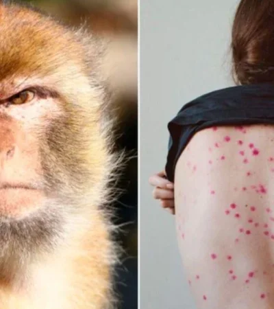 viruela-del-mono-estados-unidos-enfermedad-contagio-png.