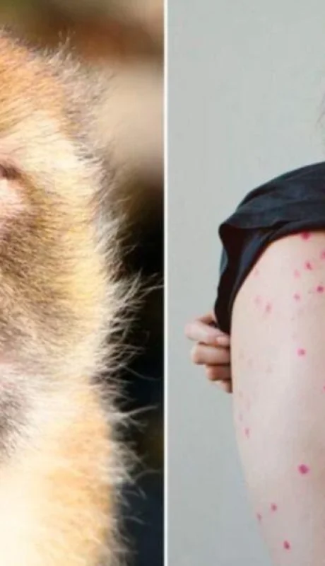 viruela-del-mono-estados-unidos-enfermedad-contagio-png.