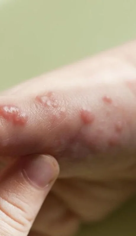 como-se-contagia-la-viruela-del-mono-52281-orig-jpg.