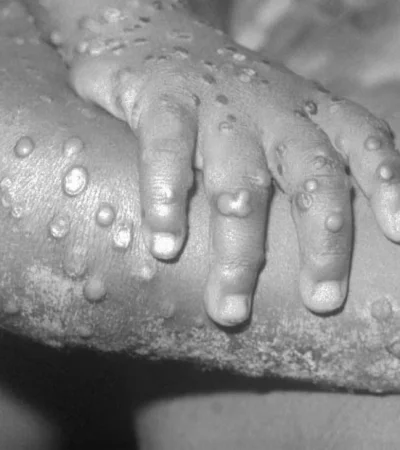 viruela-del-mono-jpg.