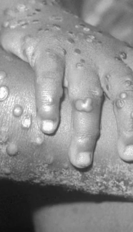 viruela-del-mono-jpg.