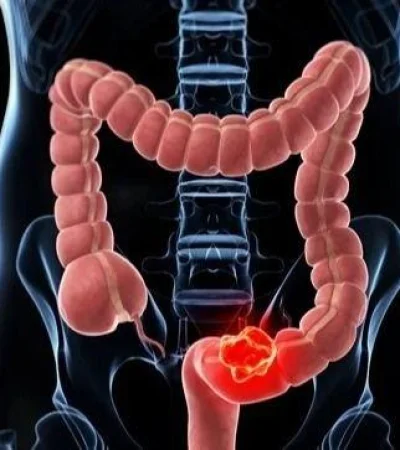 cancer-colon-jpg.