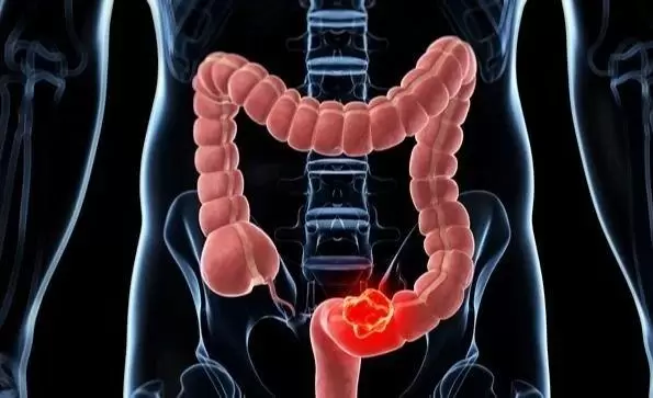 cancer-colon-jpg.