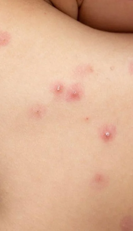 que-es-la-viruela-del-mono-png.