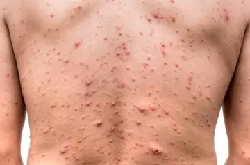 Suecia declara la alerta por una preocupante enfermedad