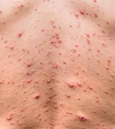 Suecia declara la alerta por una preocupante enfermedad