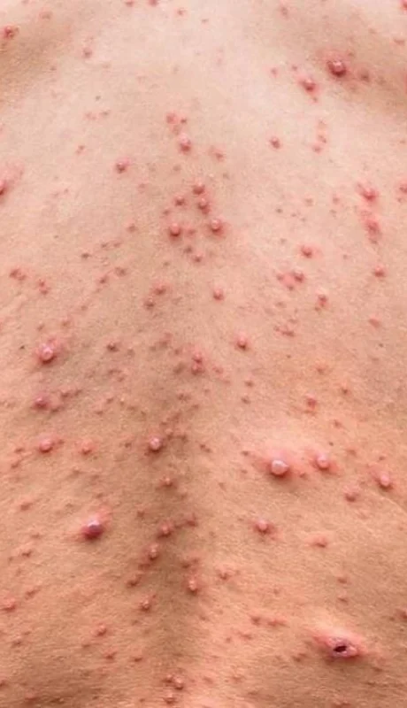 Suecia declara la alerta por una preocupante enfermedad