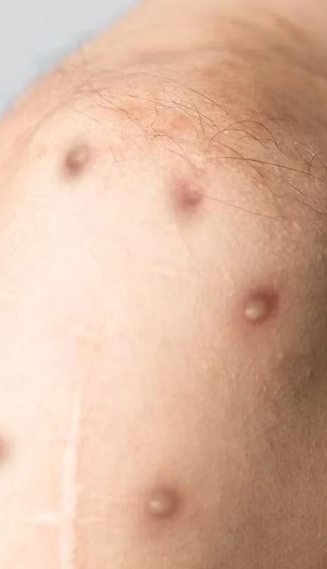 La viruela del mono preocupa al mundo