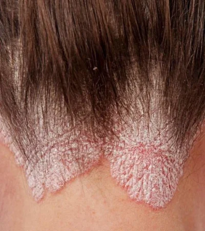 psoriasis-jpg.