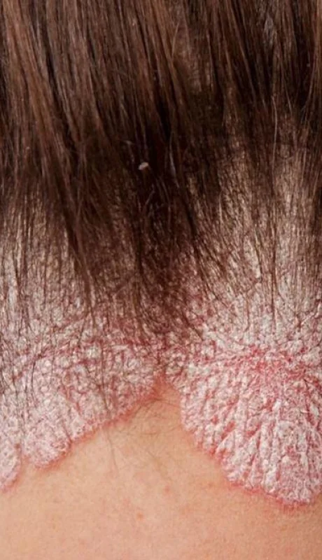psoriasis-jpg.