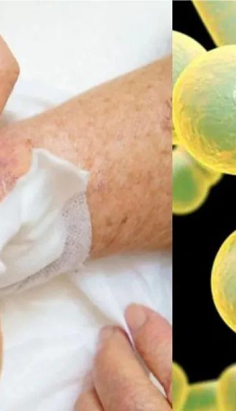 hongo-candida-auris-png.