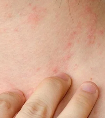 eccema-750x425-1-jpg.