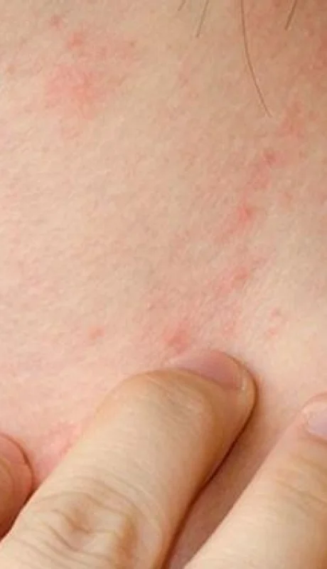 eccema-750x425-1-jpg.