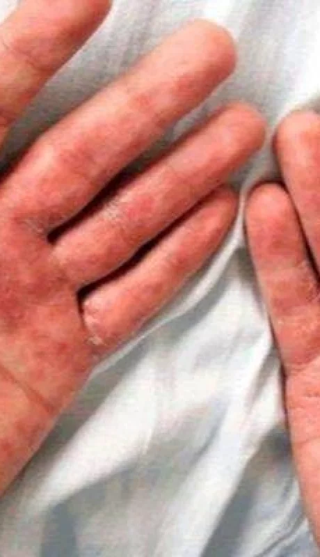 sifilis-735x400-jpg.