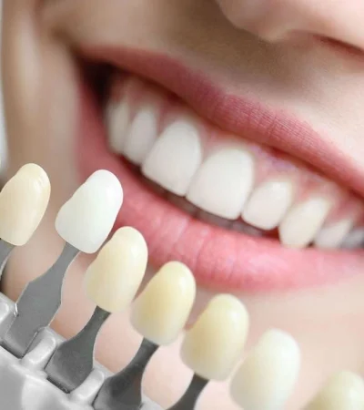 blanqueamiento-dental-jpg.