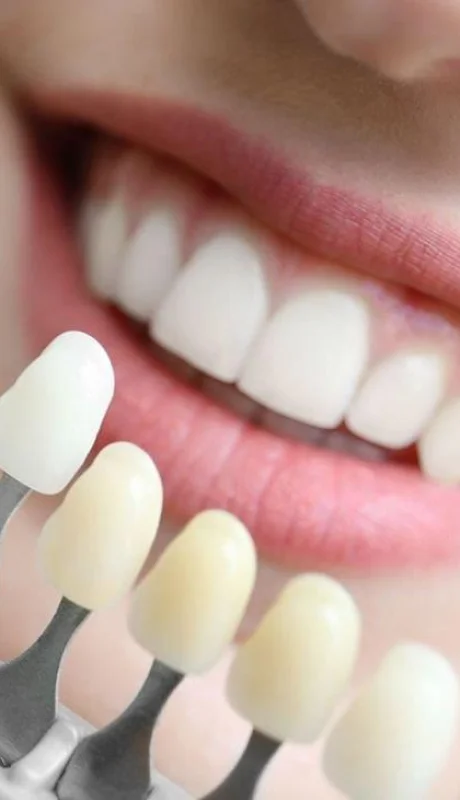 blanqueamiento-dental-jpg.