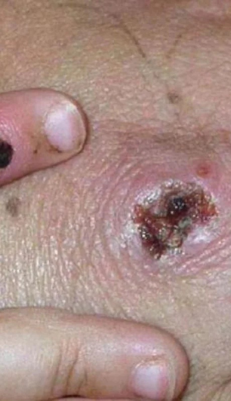 180912092928-monkeypox-symtpoms-file-super-tease-jpg.