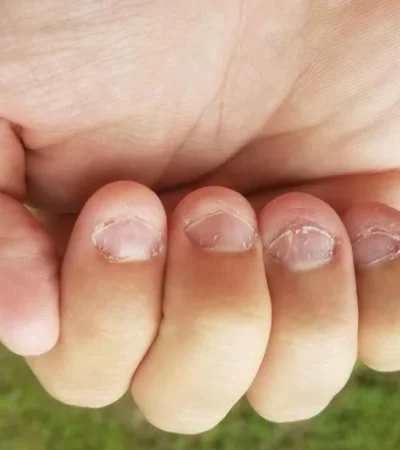 onicofagia-morderse-las-unas-jpg.