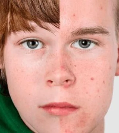 pubertad-precoz-png.