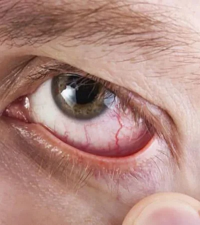 sindrome-de-sjogren-ojos-salud-ocular-png.