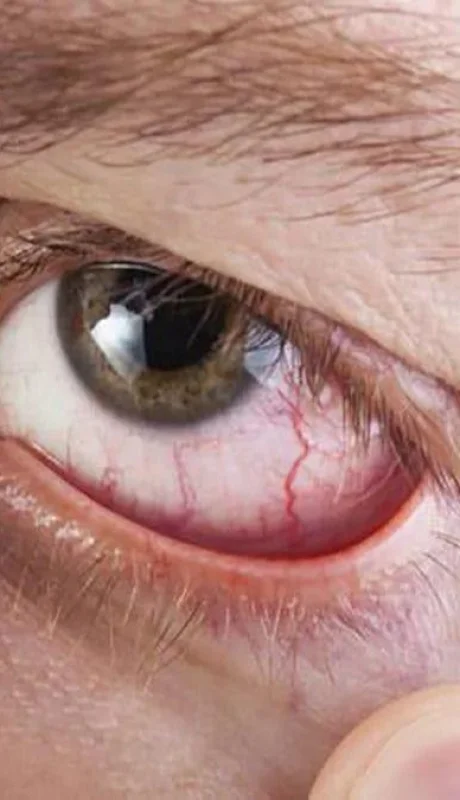 sindrome-de-sjogren-ojos-salud-ocular-png.