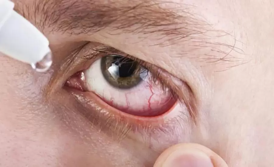 sindrome-de-sjogren-ojos-salud-ocular-png.