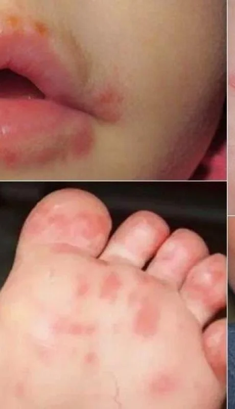 enfermedad-pie-mano-boca--deben-de-acudir-al-colegio-jpg.