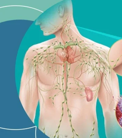 20-08-19-linfoma-1080x675-1-jpg.