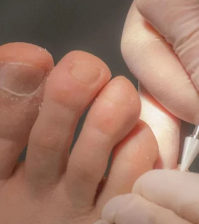 onicomicosis-tratamiento-jpg.