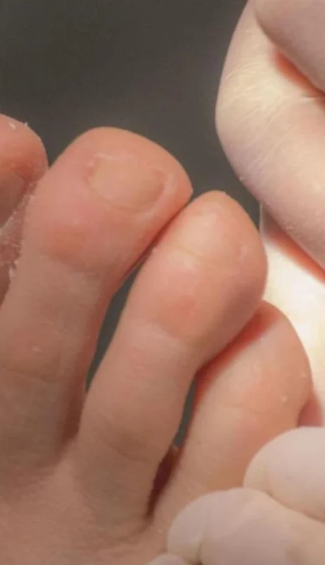 onicomicosis-tratamiento-jpg.