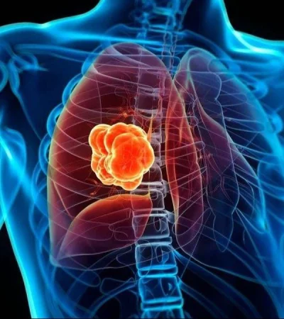 cancer-de-pulmon-jpg.