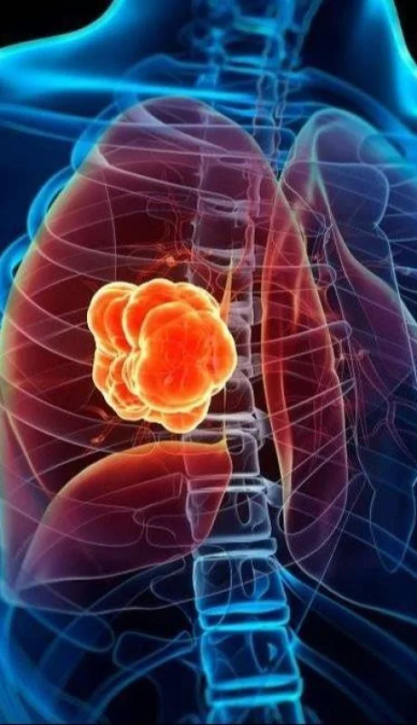 cancer-de-pulmon-jpg.
