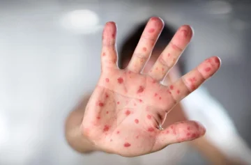 Alerta por una variante del sarampión que escapa a las pruebas