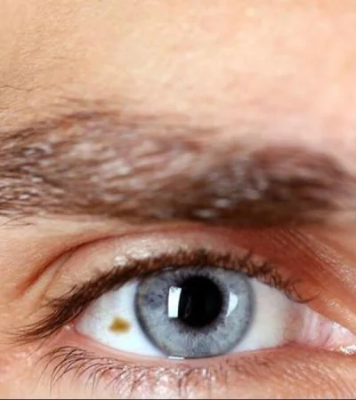 sintomas-signos-melanoma-potencial-metastasico-1712539145-164531040-1200x675-jpg.