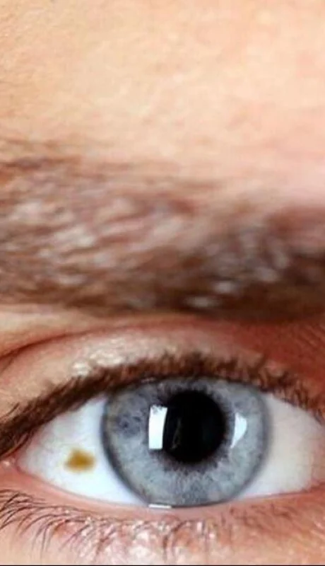 sintomas-signos-melanoma-potencial-metastasico-1712539145-164531040-1200x675-jpg.